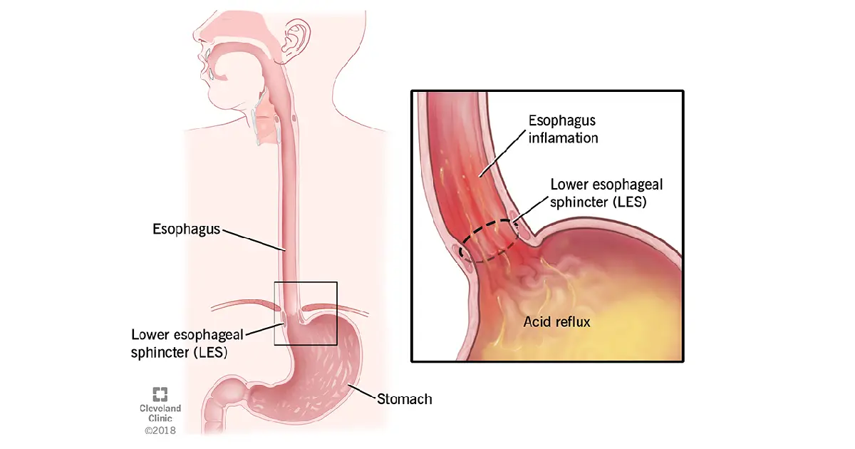 Cómo aliviar la gastritis y el reflujo de forma natural: guía completa y beneficios del Aloe