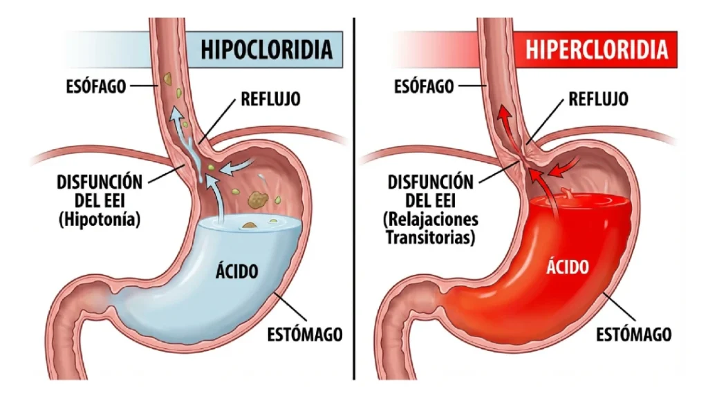 Reflujo: hiper e Hipocloridia